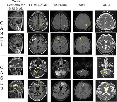 A Methodology to Compare Biomechanical Simulations With Clinical Brain Imaging Analysis Utilizing Two Blunt Impact Cases